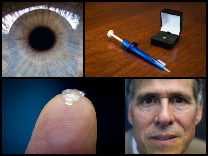 ocumetics仿生晶体 不动手术十分钟治疗近视